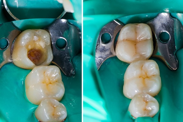 Mimicking Nature In Dentistry