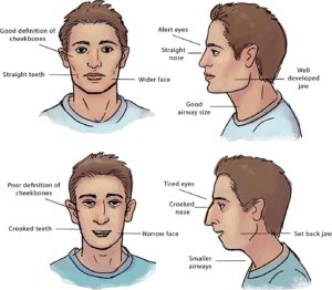 Nasal Breathing Assessment - Dr. Dina Pediatric Dentistry Clinic