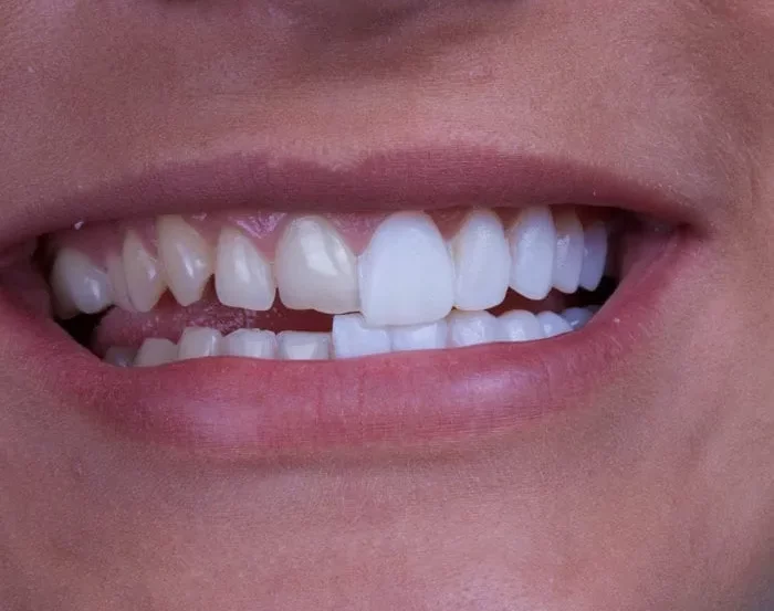 veneers 2