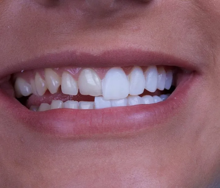 veneers 2